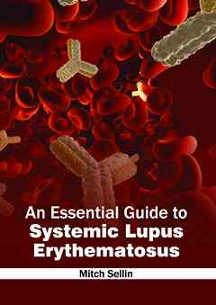 Essential Guide to Systemic Lupus Erythematosus