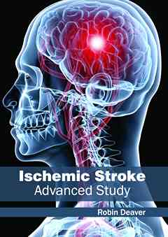 Ischemic Stroke: Advanced Study