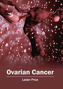 Ovarian Cancer