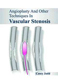 Angioplasty and Other Techniques in Vascular Stenosis