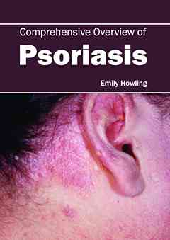 Comprehensive Overview of Psoriasis