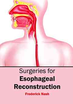 Surgeries for Esophageal Reconstruction