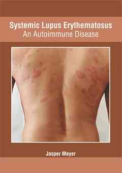 Systemic Lupus Erythematosus: An Autoimmune Disease