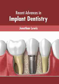 Recent Advances in Implant Dentistry