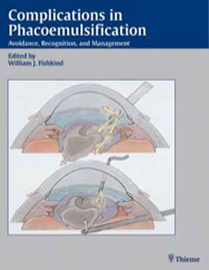 Complications in Phacoemulsification: Avoidance, Recognition, and Management  1st