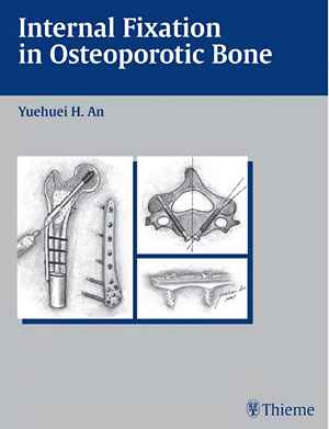 Internal Fixation in Osteoporotic Bone 1st
