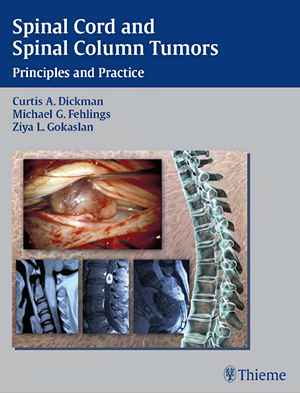 Spinal Cord and Spinal Column Tumors