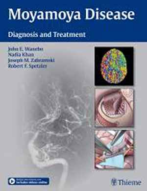 Moyamoya Disease: Diagnosis and Treatment 1st