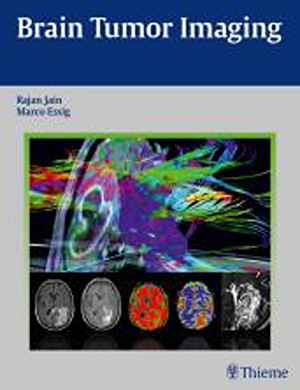 Brain Tumor Imaging  1st