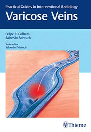 Varicose Veins: Practical Guides in Interventional Radiology 1st