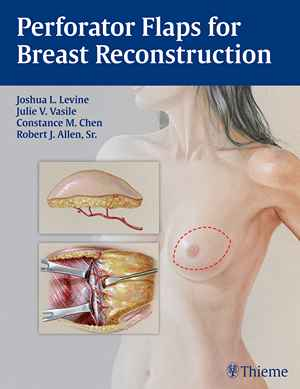 Perforator Flaps for Breast Reconstruction  1st
