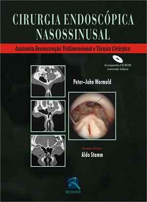 Cirurgia Endoscopica Nasossinusal: Anatomia, Reconstrução Tridimensional e Técnica Cirúrgica