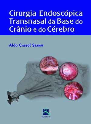 Cirurgia Endoscópica Transnasal da Base do Crânio