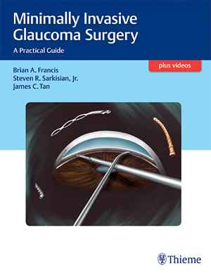 Minimally Invasive Glaucoma Surgery: A Practical Guide  1st