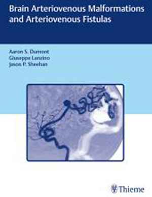 Brain Arteriovenous Malformations and Arteriovenous Fistulas 1st