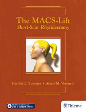 The MACS-Lift: Short-Scar Rhytidectomy  1st