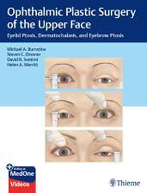 Ophthalmic Plastic Surgery of the Upper Face: Eyelid Ptosis, Dermatochalasis, and Eyebrow Ptosis  1st