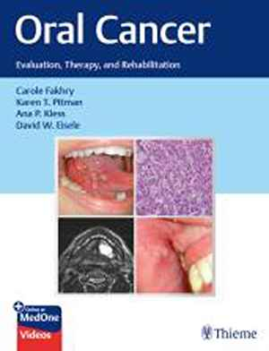 Oral Cancer: Evaluation, Therapy, and Rehabilitation  1st