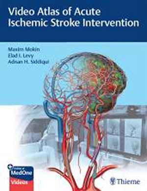 Video Atlas of Acute Ischemic Stroke Intervention  1st