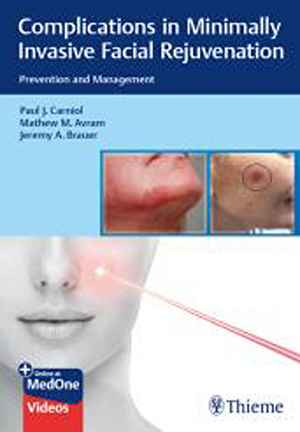 Complications in Minimally Invasive Facial Rejuvenation: Prevention and Management  1st
