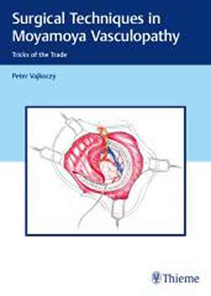 Surgical Techniques in Moyamoya Vasculopathy: Tricks of the Trade 1st