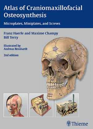 Atlas of Craniomaxillofacial Osteosynthesis: Microplates, Miniplates, and Screws  2nd