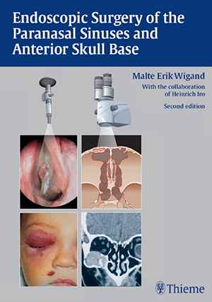 Endoscopic Surgery of the Paranasal Sinuses and Anterior Skull Base 2nd