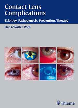 Contact Lens Complications: Etiology, Pathogenesis, Prevention, Therapy 1st