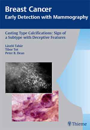 Breast Cancer: Early Detection with Mammography: Casting-Type Calcifications: Sign of a Subtype with Deceptive Features  1st