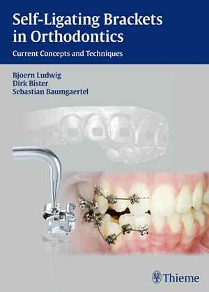 Self-Ligating Brackets in Orthodontics