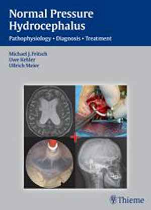 Normal Pressure Hydrocephalus: Pathophysiology - Diagnosis - Treatment  1st