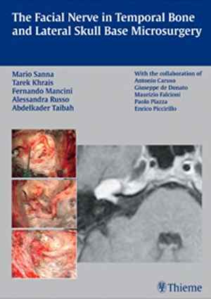 Facial Nerve in Temporal Bone and Lateral Skull Base Microsurgery 1st