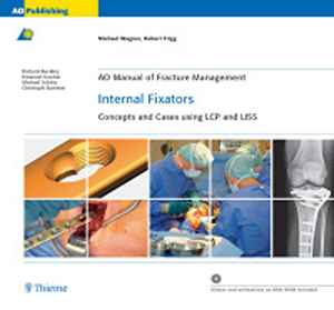 AO Manual of Fracture Management: Internal Fixators: Concepts and Cases using LCP and LISS  1st