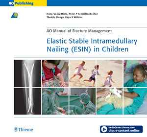 Elastic Stable Intramedullary Nailing (ESIN) in Children 1st