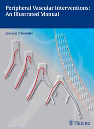Peripheral Vascular Interventions: An Illustrated Manual 1st
