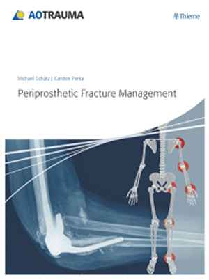 Periprosthetic Fracture Management  1st