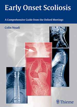 Early Onset Scoliosis: A Comprehensive Guide from the Oxford Meetings  1st