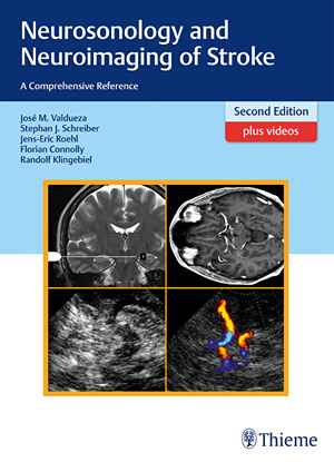 Neurosonology and Neuroimaging of Stroke: A Comprehensive Reference 2nd