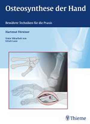 Osteosynthese der Hand