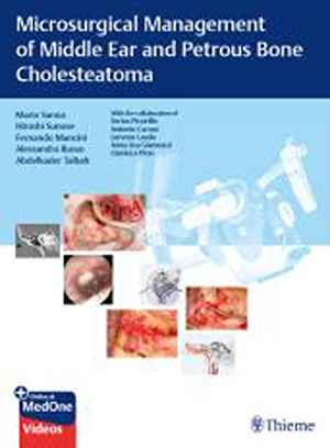 Microsurgical Management of Middle Ear and Petrous Bone Cholesteatoma 1st
