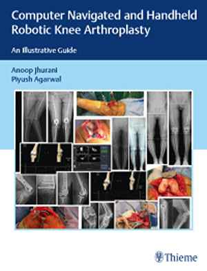 Computer Navigated and Handheld Robotic Knee Arthroplasty: An Illustrative Guide  1st