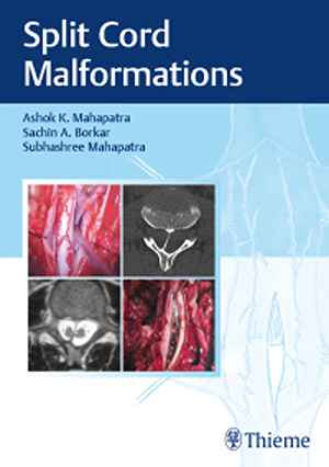 Split Cord Malformations 1st