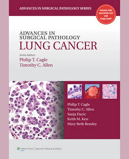 Advances in Surgical Pathology: Lung cancer