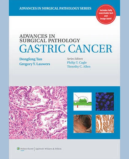 Advances in Surgical Pathology: Gastric Cancer