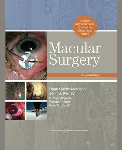 Macular Surgery