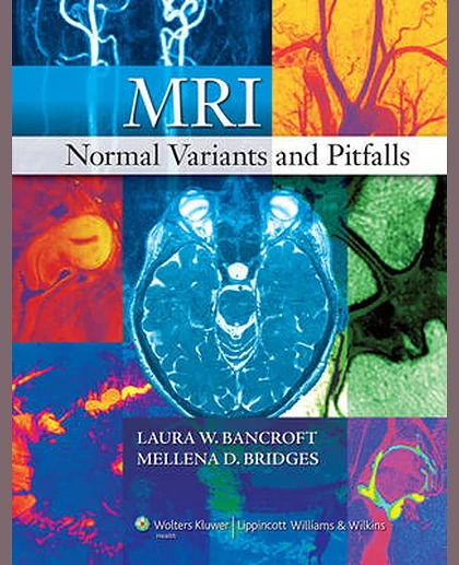 MRI Normal Variants and Pitfalls