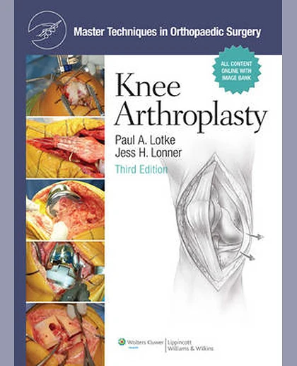 Knee Arthroplasty