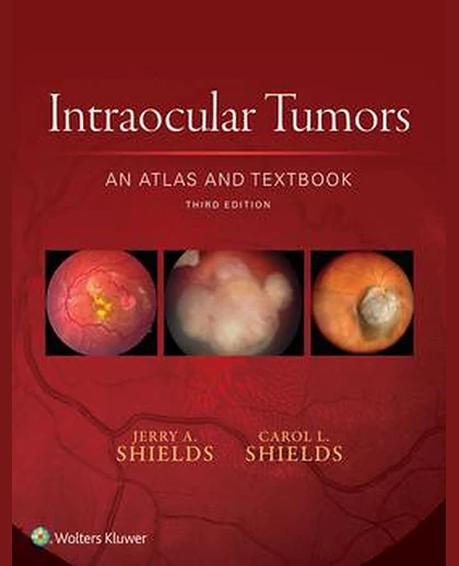 Intraocular Tumors: An Atlas and Textbook
