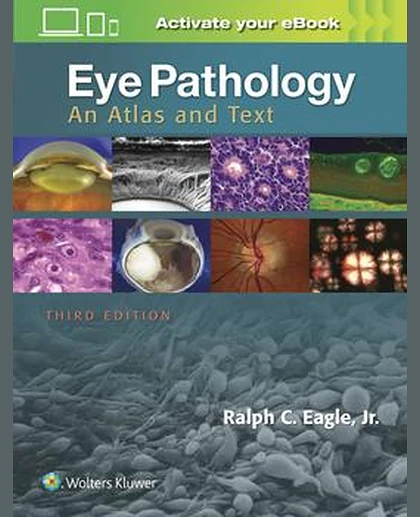 Eye Pathology