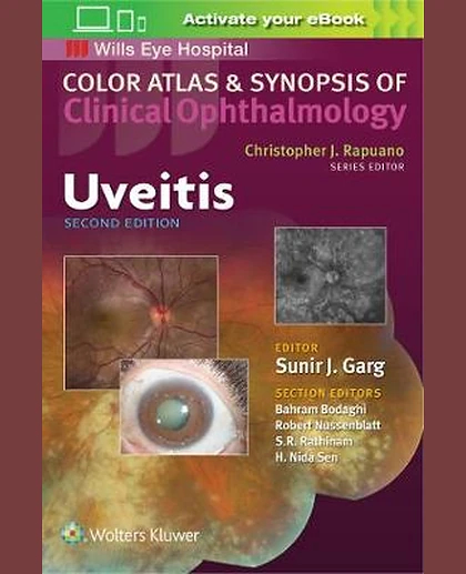 Uveitis